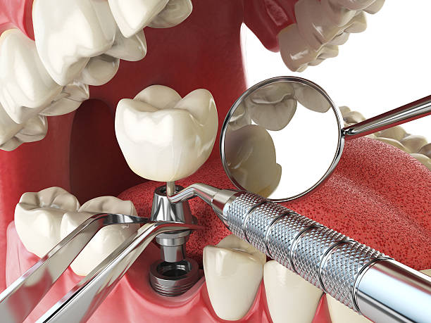 Best Emergency Treatment for Dental Infections or Abscesses in Paris, TX